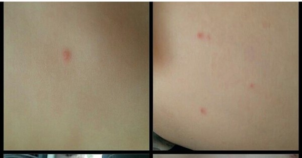 Is it the dreaded pox?