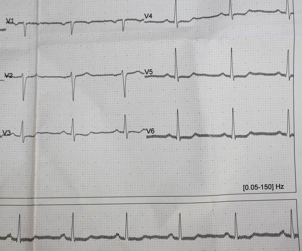 Borderline ECG