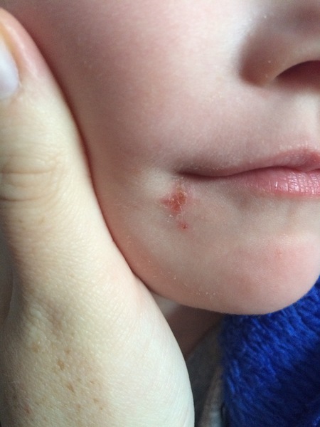 Is this a cold sore on DS??