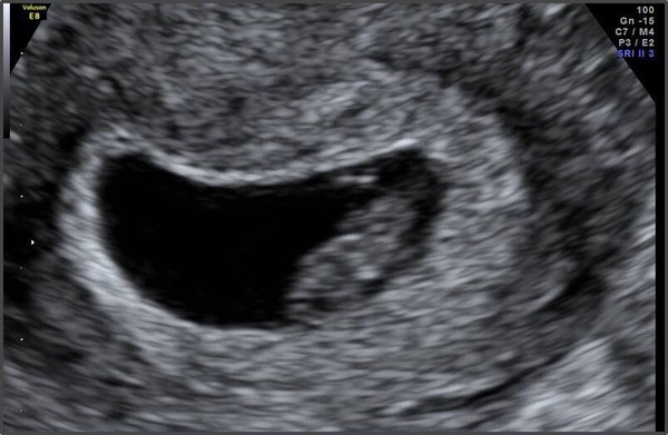 Early pregnancy x
