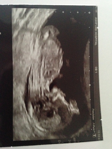 April 2017 #4 More baby scans, less morning sickness!