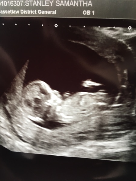April 2017 #4 More baby scans, less morning sickness!