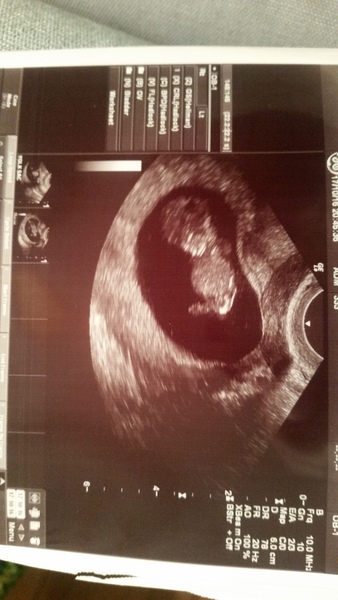 May 2017 Thread #2 - sore boobs, early scans & feeling rather queasy!