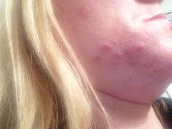 Any skin experts around ? Pics