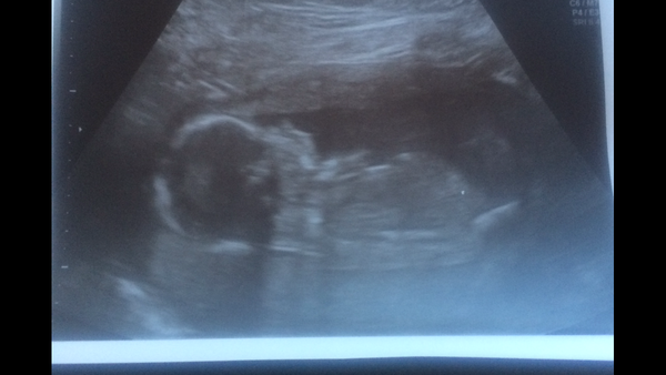 Pregnancy after infertility II