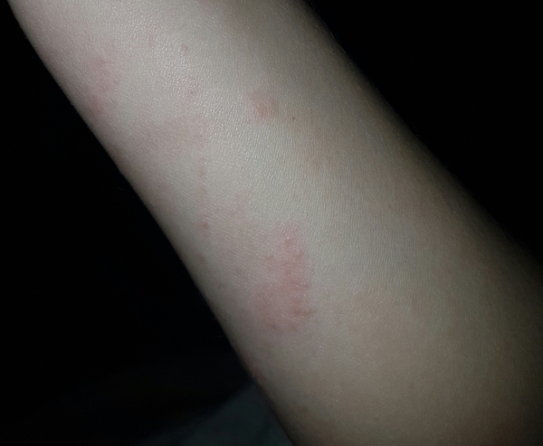 Can anyone help with this rash?