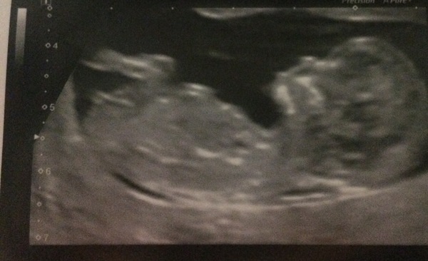 April 2017 #4 More baby scans, less morning sickness!