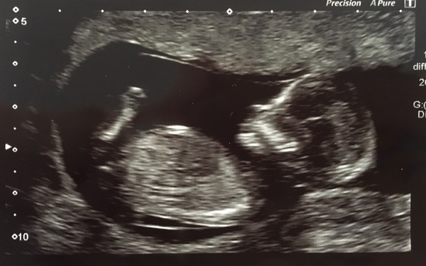 April 2017 #4 More baby scans, less morning sickness!