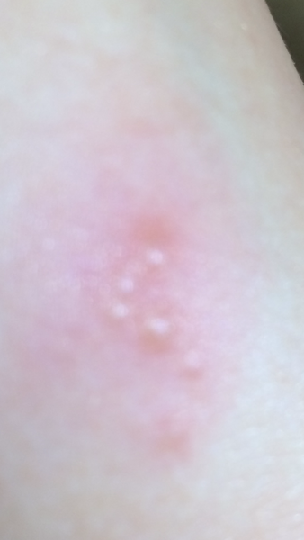 Rash or spots?