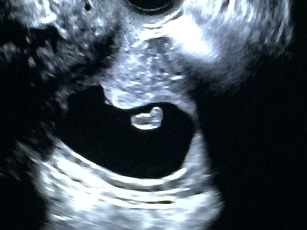 April 2017 #4 More baby scans, less morning sickness!