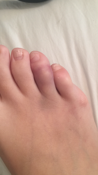 Broken Toe