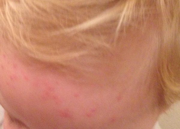 Mystery rash