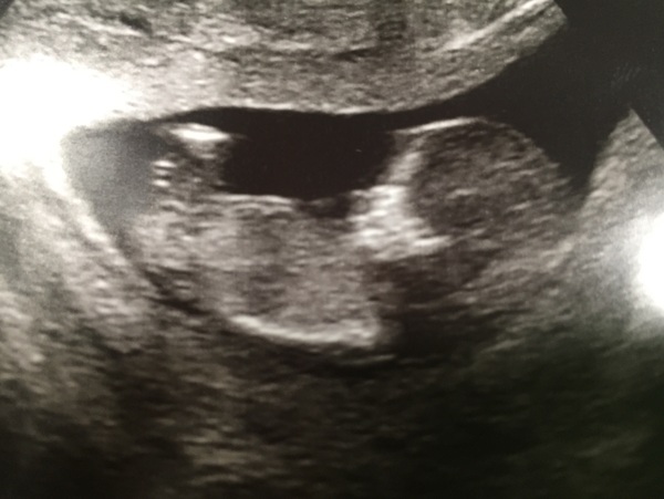 April 2017 #4 More baby scans, less morning sickness!