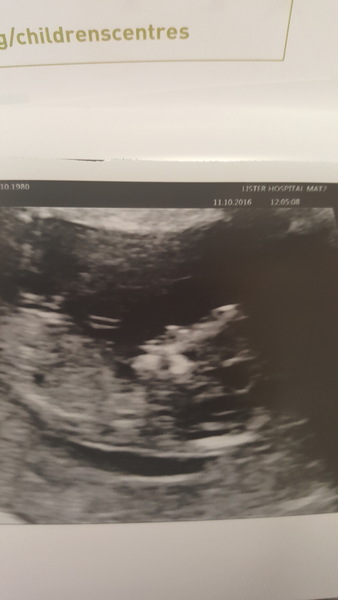 April 2017 #4 More baby scans, less morning sickness!