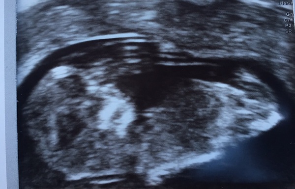 Boy or Girl?