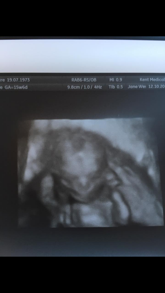 Pregnancy after infertility II