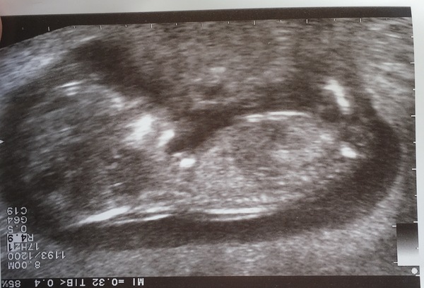 April 2017 #4 More baby scans, less morning sickness!
