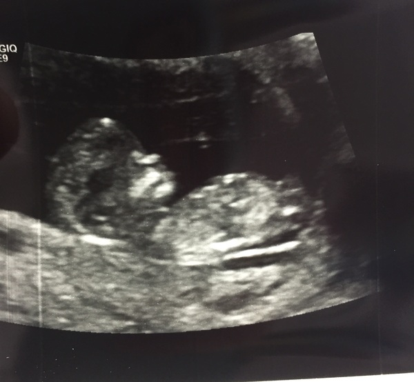 April 2017 #4 More baby scans, less morning sickness!