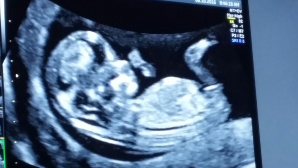 April 2017 #4 More baby scans, less morning sickness!