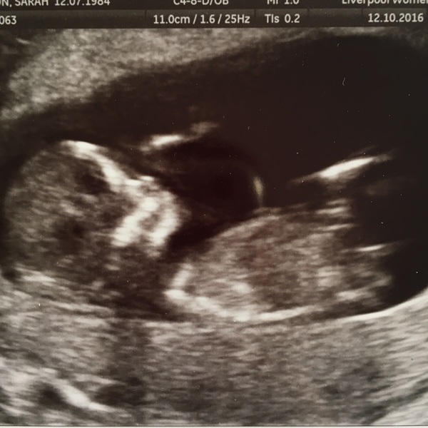 April 2017 #4 More baby scans, less morning sickness!