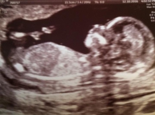 April 2017 #4 More baby scans, less morning sickness!