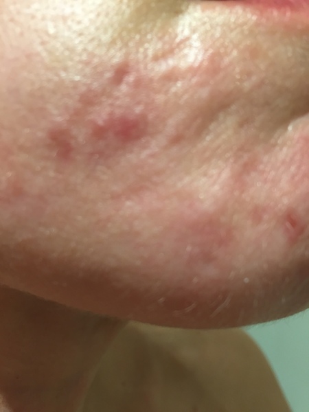 I'm nearly 50 and my skin is awful. Scary photo included