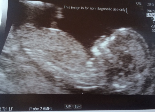 April 2017 #4 More baby scans, less morning sickness!