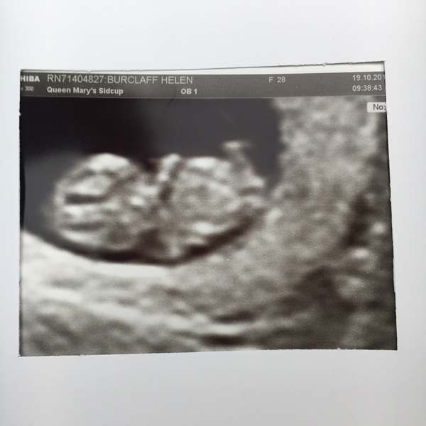 May 2017 Thread #2 - sore boobs, early scans & feeling rather queasy!