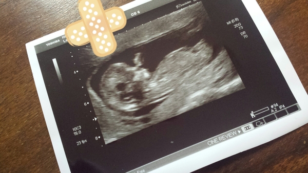 April 2017 #4 More baby scans, less morning sickness!