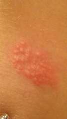 Help! Skin condition or insect bites?!