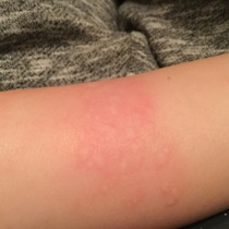 Secondary rash following chicken pox (pics)?