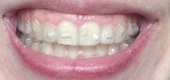 Invisalign - do you have to get the white lumpy bits?