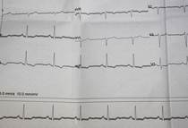 Borderline ECG