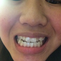 Invisalign - do you have to get the white lumpy bits?
