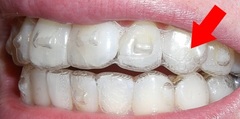 Invisalign - do you have to get the white lumpy bits?
