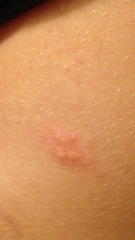 Help! Skin condition or insect bites?!