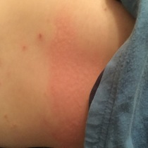 Secondary rash following chicken pox (pics)?