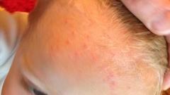 Mystery rash
