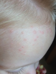 Mystery rash