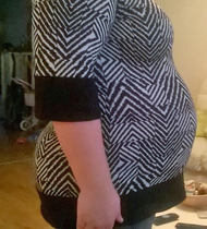 Essure permanent sterilisation