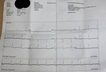 Borderline ECG