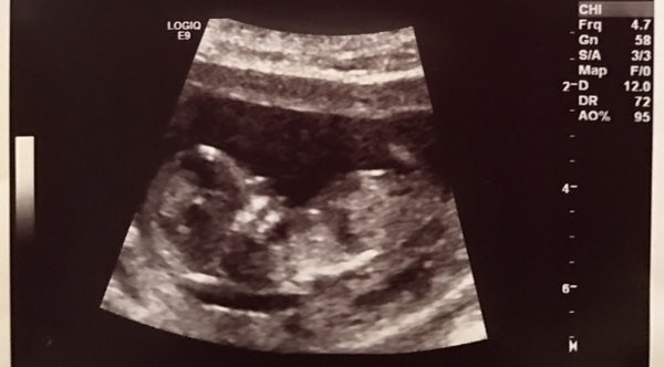 Due in June, 12 week scans happening and coming up!