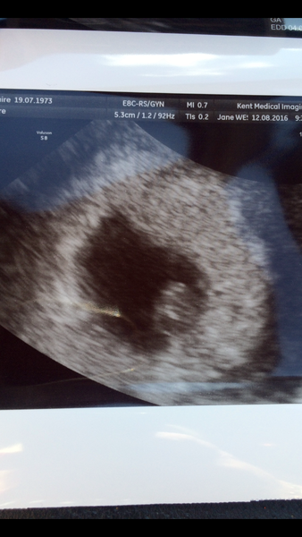 Anyone had a scan at 6 weeks