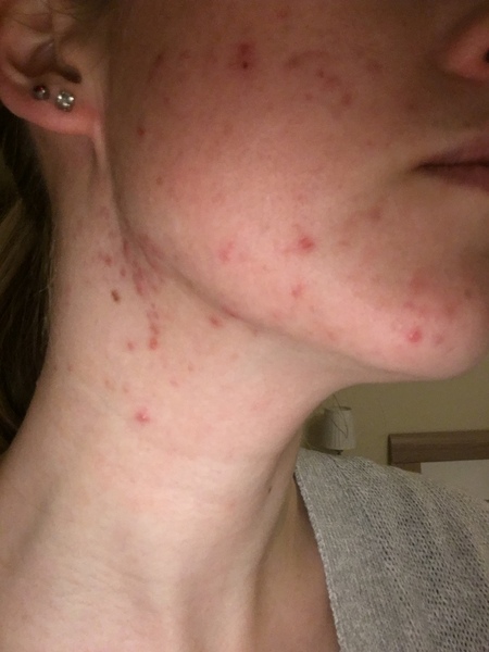 Adult acne - help me!