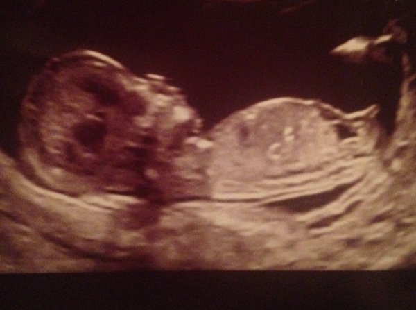 Scan picture, can I already see a penis?!