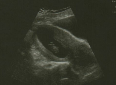 Would I be silly to get an early scan