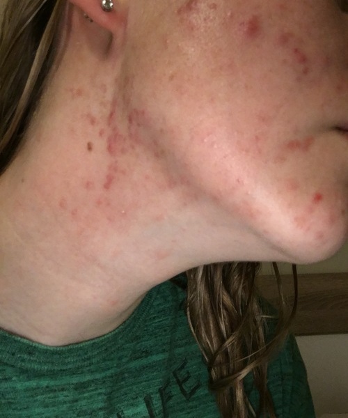 Adult acne - help me!