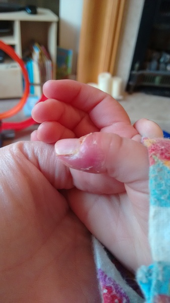 How to treat DSs thumb