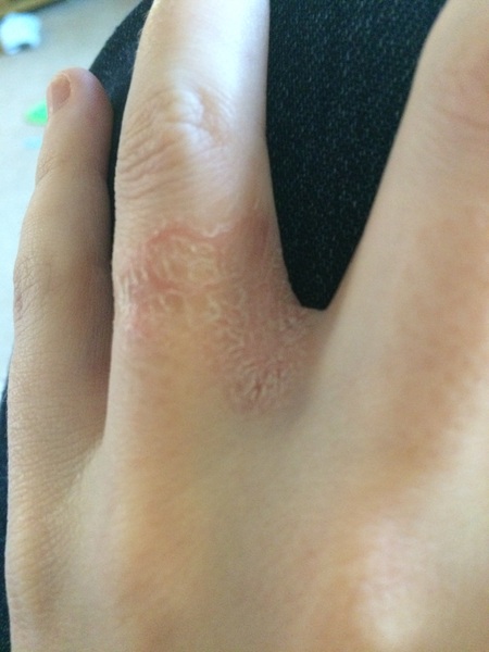 Manky finger!!
