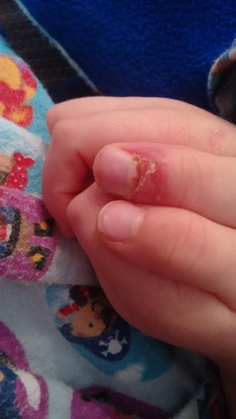 How to treat DSs thumb